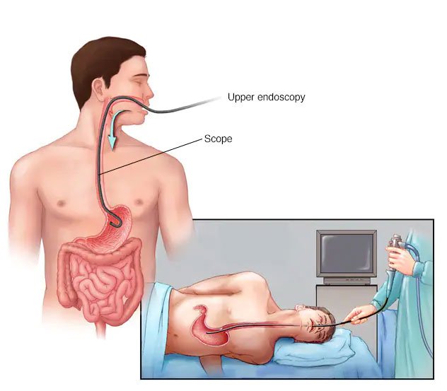 Upper GI Endoscopy